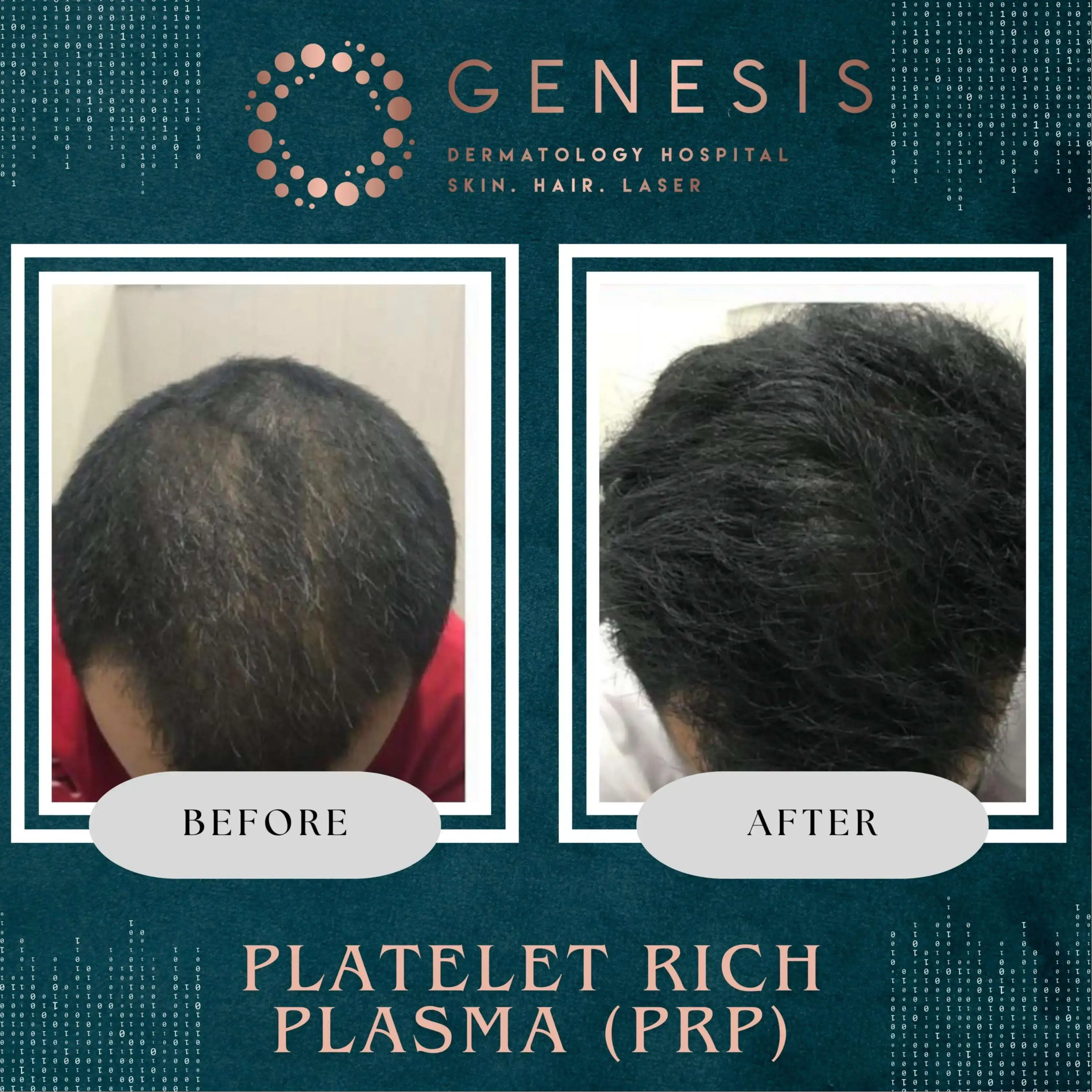 PRP Hair Treatment