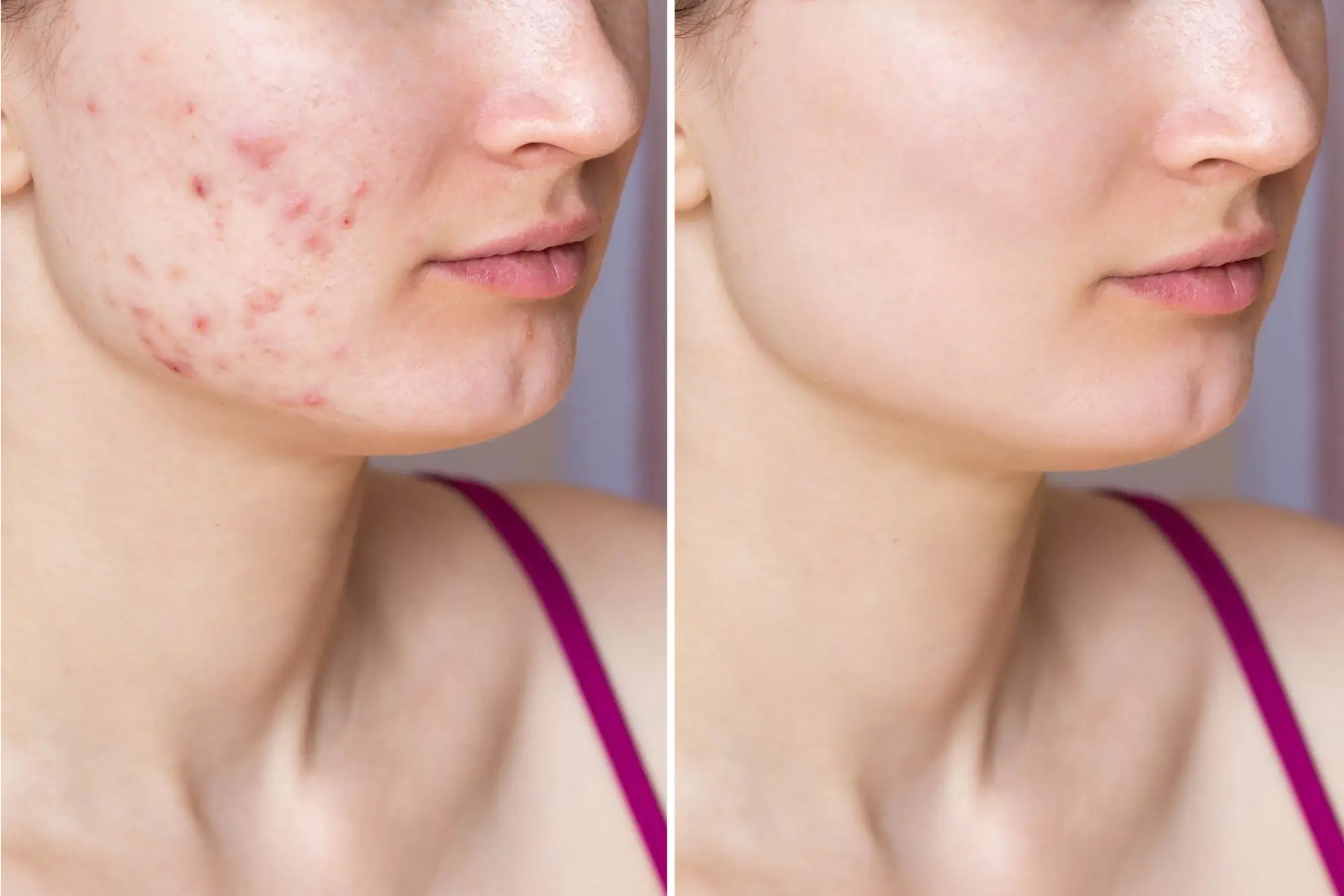 Acne Scars