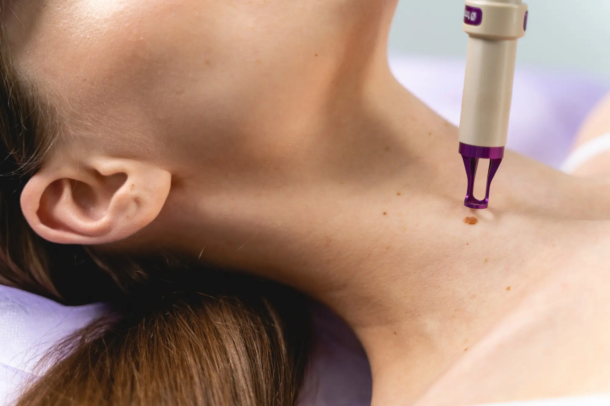  Moles Removal Treatment